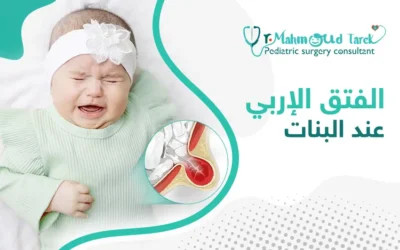 هل يحدث الفتق الأربي عند البنات؟ وما أعراضه؟