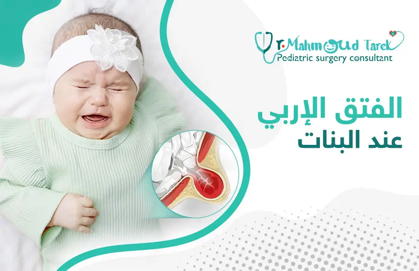الفتق الأربي عند البنات