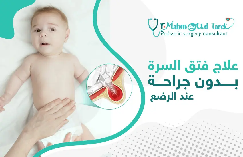 علاج فتق السرة بدون جراحة عند الرضع