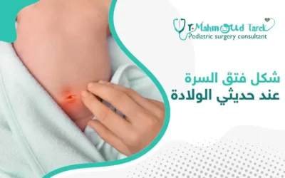 شكل فتق السرة عند حديثي الولادة