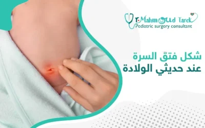 شكل فتق السرة عند حديثي الولادة
